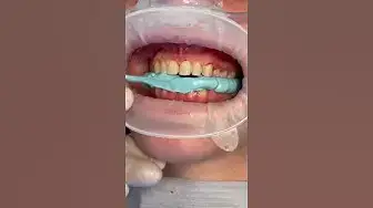 Video thumbnail for #shorts #cleaning 😁#veneers #braces #implant #dental #dentist #shortvideo whats 😱😱