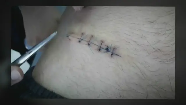 Video thumbnail for Skidanje šavova (konaca) nakon operacije
