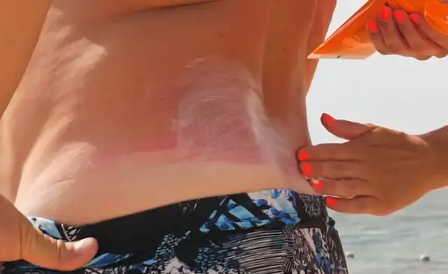 Video thumbnail for Doctor shares ways to prevent sunburn and protect skin during summer