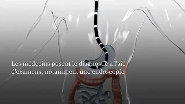 Video thumbnail for Kim Kardashian souffre d'une œsophagite.