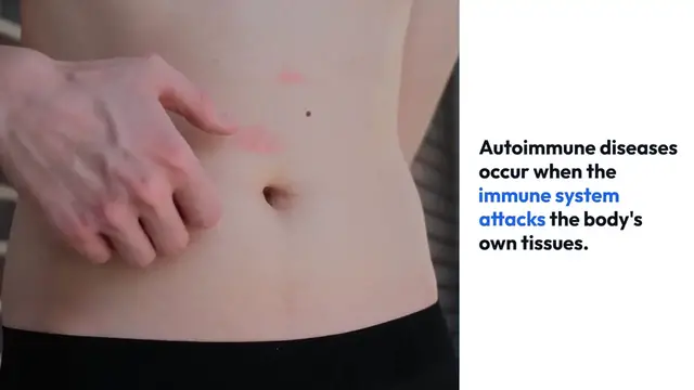 Video thumbnail for Understanding Autoimmune Diseases