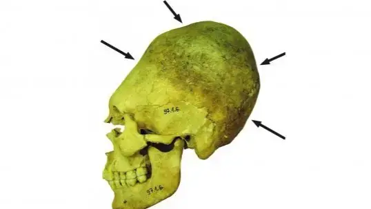 Video thumbnail for Inside Hungary's ancient cemetery: 51 deformed skulls and clues on Rome's fall