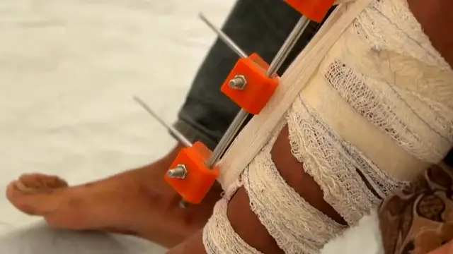 Video thumbnail for Gaza doctors create 3D-printed devices to save patients from amputation