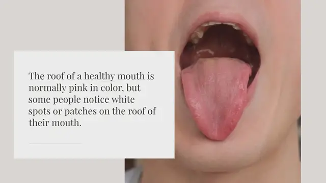 Video thumbnail for Is the roof of your mouth supposed to be white?