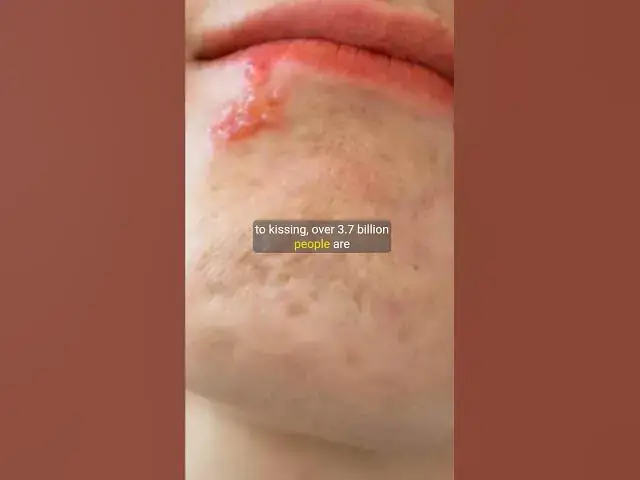 Video thumbnail for Human Herpes Linked to Emergence of Kissing in the Bronze Age