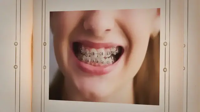 'Video thumbnail for Escogiendo el Color de Brackets Ideal para Piel Morena'