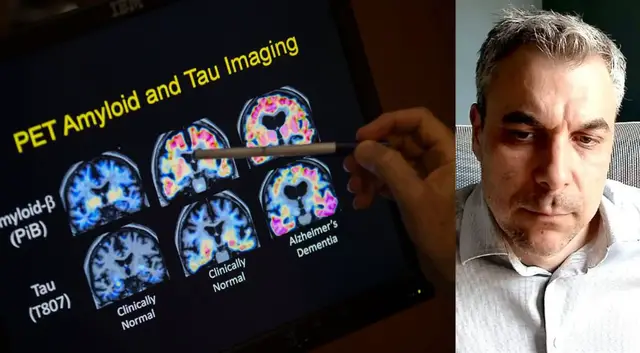 Video thumbnail for Can dementia be prevented? Expert explains key risk factors and warning signs
