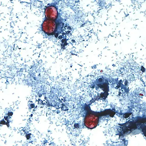 Video thumbnail for Parasite linked to contaminated produce spreads across U.S., doctor urges caution