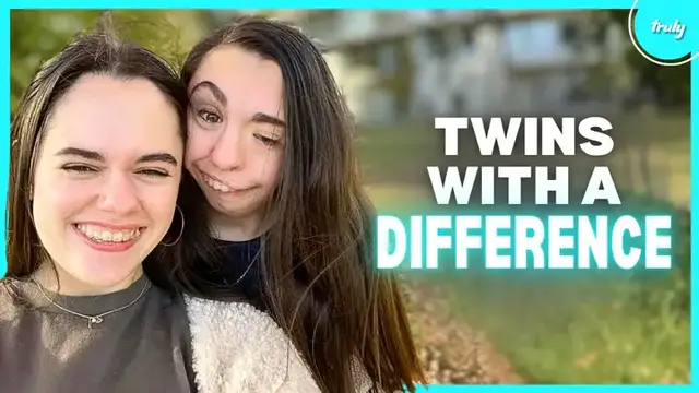 Video thumbnail for My Twin Was Born Without An Ear & Jawbone | BORN DIFFERENT