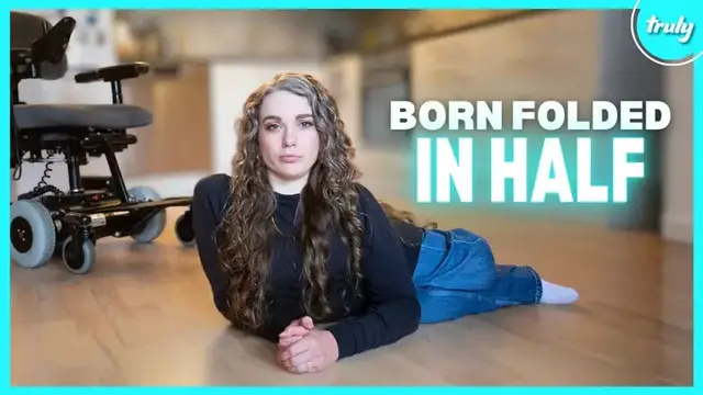 'Video thumbnail for My Body Was Folded In Half When I Was Born | BORN DIFFERENT'