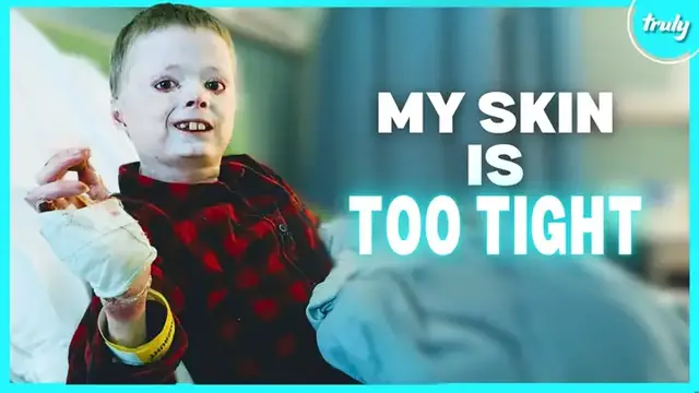 Video thumbnail for My Skin Is Too Tight For My Body | BORN DIFFERENT