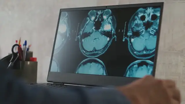 Video thumbnail for Pheochromocytoma: Symptoms, Causes, and Treatment