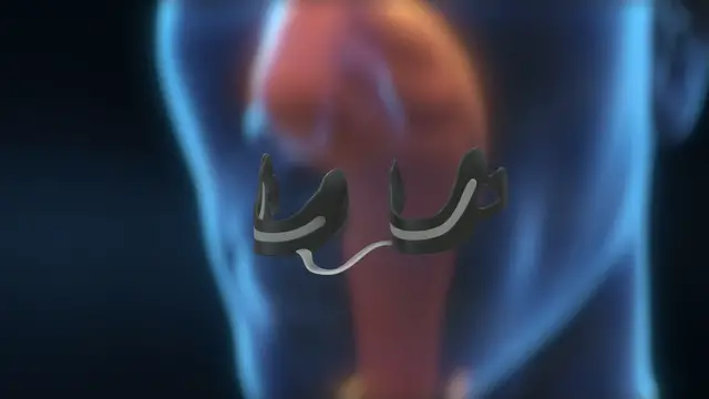 'Video thumbnail for Easy Stop Snoring Cure'