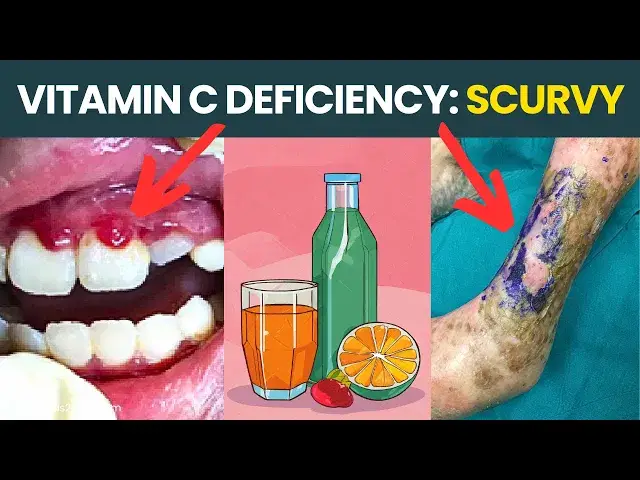 Video thumbnail for Vitamin C Deficiency Diseases Like Scurvy: Scary Symptoms Explained