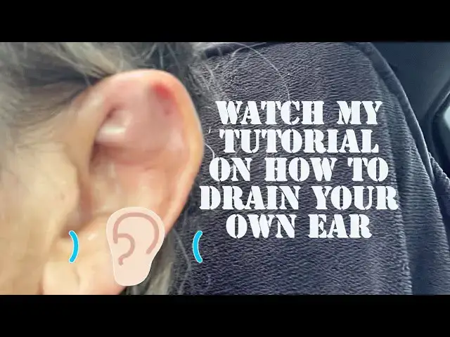 Video thumbnail for Cauliflower ear draining. I did it to myself.