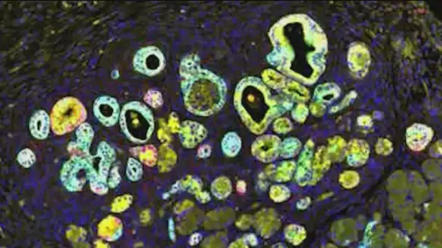 Video thumbnail for LI scientists make pancreatic cancer breakthrough