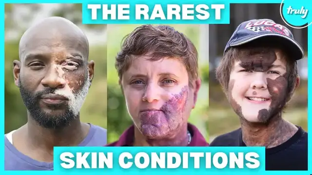 'Video thumbnail for The World's Rarest Skin Conditions | BORN DIFFERENT'