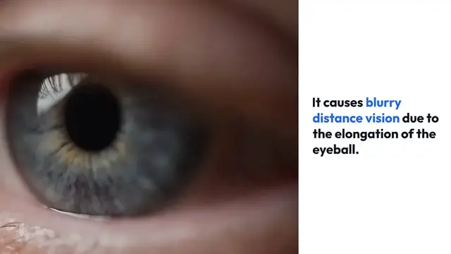 Video thumbnail for Myopia Causes and Prevention Guide