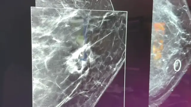 Video thumbnail for Tiny speck, big warning: Floral Park woman’s mammogram detects cancer no one could see or feel