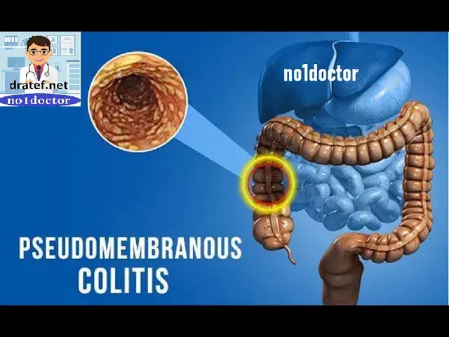Video thumbnail for Pseudomembranous Enterocolitis /Clostridium Difficile Infection /Causes / Diagnosis/Treatment /Usmle
