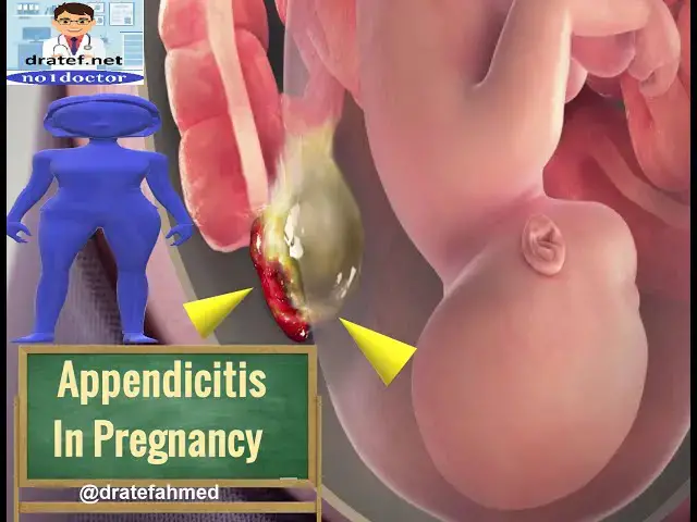 Video thumbnail for Acute Appendicitis in Pregnancy ,Symptomes ,Signs ,Diagnosis Investigations,Treatment,Complications