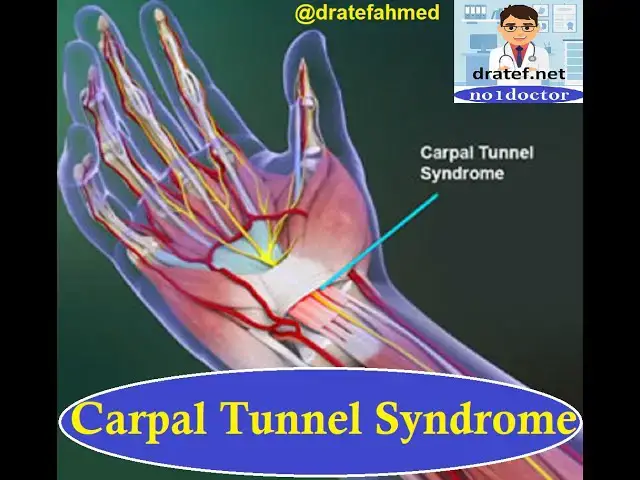 Video thumbnail for Carpal Tunnel Syndrome / Wrist Pain / Tendonitis / Medical Exame / Dratef / Median Nerve / No1doctor
