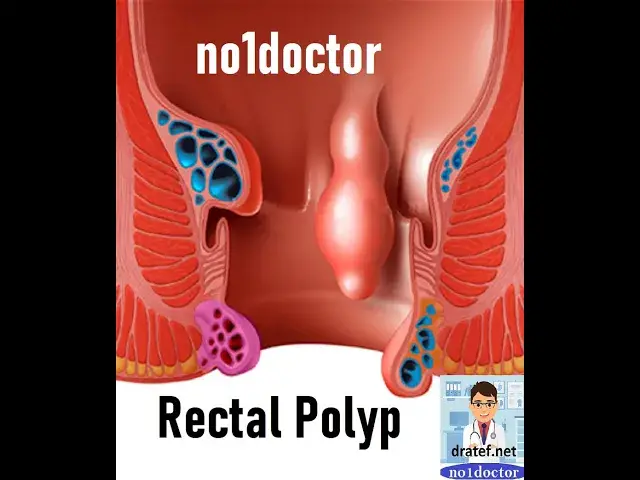 Video thumbnail for Rectal Polype/Causes/Signs and Symptoms/ Diagnosis and Treatment/colorectal/surgery/polypectomy/frcs