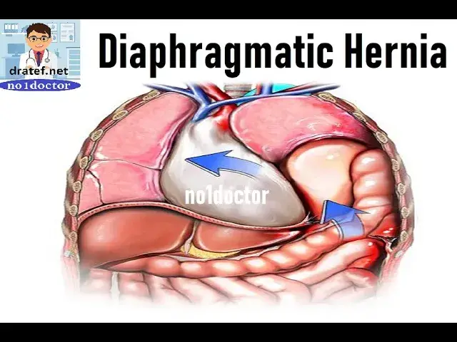 Video thumbnail for Diaphragmatic hernias / Diaphragm / Hiatal Hernia/Sliding hernia/congenital hernia /Traumatic Hernia