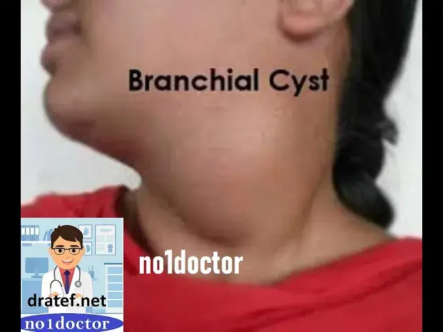 Video thumbnail for Branchial cyst  /Sinus/Fistula/Neck Mass/ Lymph Nodes/Congenital Anomalies/Anatomy/Neck triangles