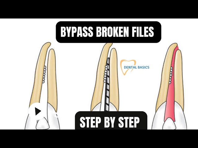 Video thumbnail for Easily Bypass Broken Files | A Clinical Guide
