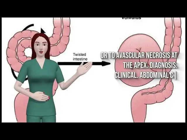 'Video thumbnail for SIGMOID VOLVULUS'