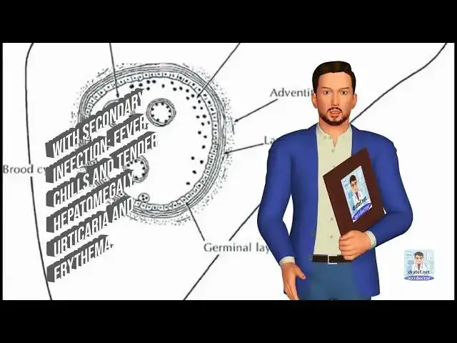 Video thumbnail for HYDATID CYST OF THE LIVER