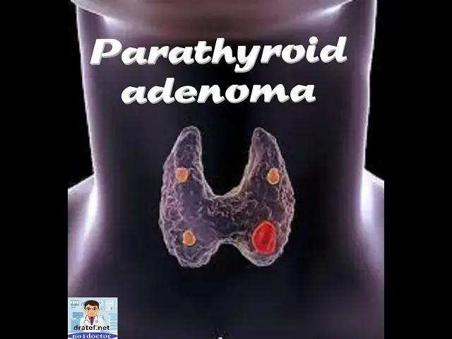 Video thumbnail for Parathyroid adenoma/ parathyroid hyperplasia/parathyroid carcinoma Parathyroid surgery/no1doctor