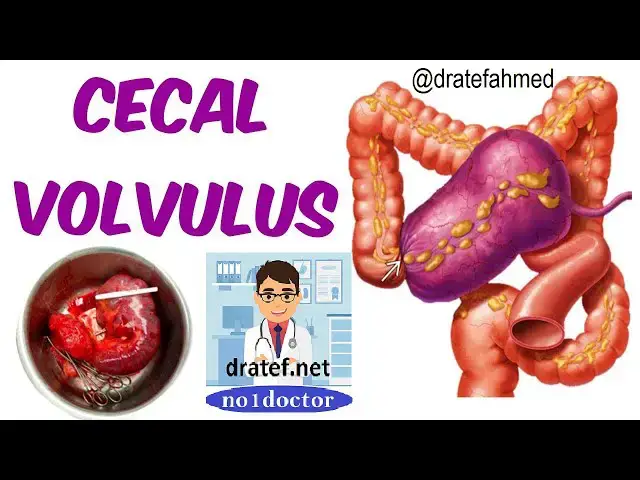 Video thumbnail for Cecal Volvulus / Causes / Pathology / Symptoms / Diagnosis / Treatment / Medical Lecture /No1doctor
