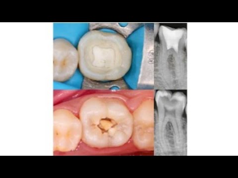 Video thumbnail for vital pulp therapy | clinical steps