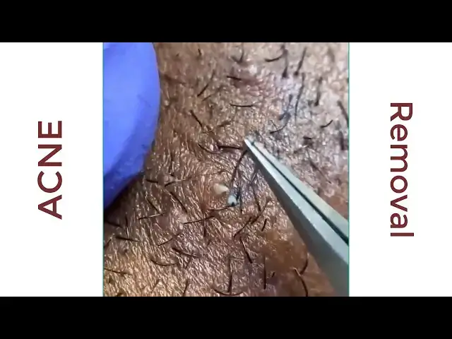 'Video thumbnail for إضاءة ليلية لمظهر جميل 02 acne DIRTY SKIN'