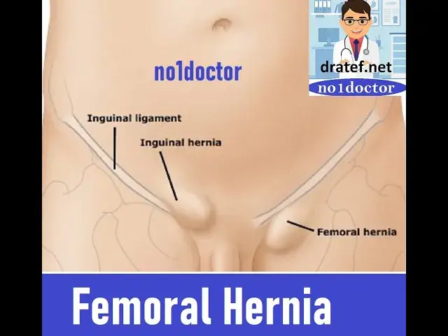 Video thumbnail for Femoral Hernia/Femoral Canal Anatomy /Groin Hernia/Inguinal /Hernia Surgery/Lap Hernia surgery