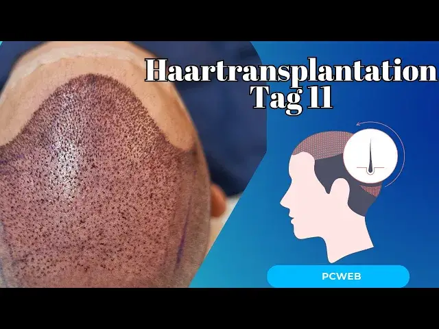 Video thumbnail for Haartransplantation Tag 11: Was passiert in dieser entscheidenden Phase?