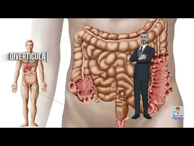 Video thumbnail for Diverticulitis  / Short Medical Notes / Medical Lecture / Medical Video / Medical Students