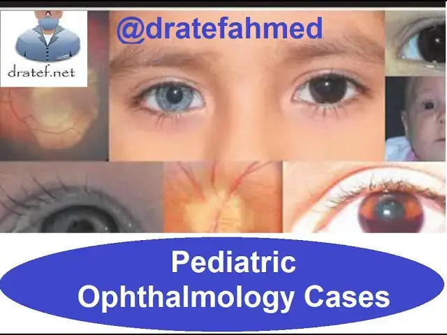 Video thumbnail for Pediatric Ophthalmology Cases/ Case Presentation / Medical Case Study   Case/ Discussion Case Report