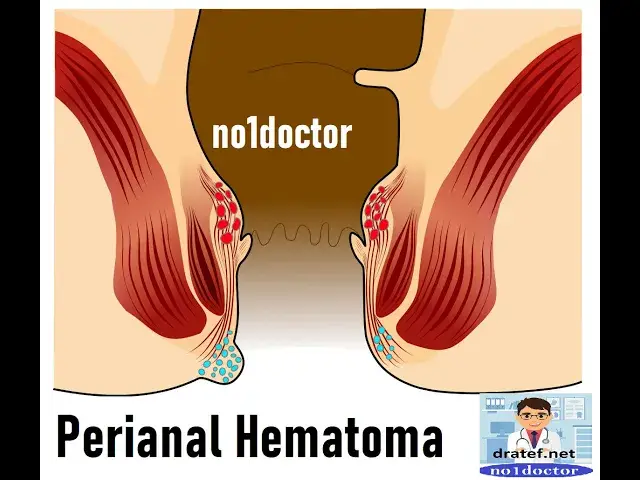 Video thumbnail for Perianal Hematoma /Piles /Hemorrhoids /Fissure /Perianal Fistula /Perianal Abscess/External Piles