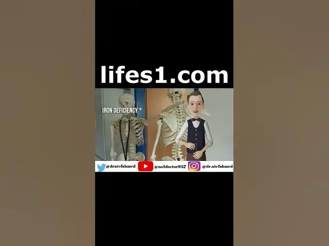 Video thumbnail for Plummer vinson Syndrome  #medicalsyndrome #syndromes #shorts  #Mrcs  #Frcs #Usmle  #MedicalStudents