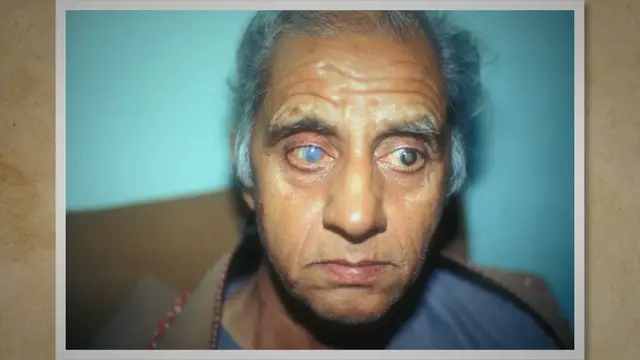 Video thumbnail for Clear Vision Ahead: Understanding Cataracts and Your Treatment Options