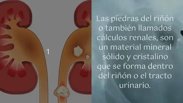 Video thumbnail for Cómo eliminar las piedras del riñón con sólo 4 ingredientes