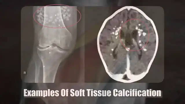 Video thumbnail for This Little Known Supplement Is The Secret To UNBREAKABLE Bones(720P HD)