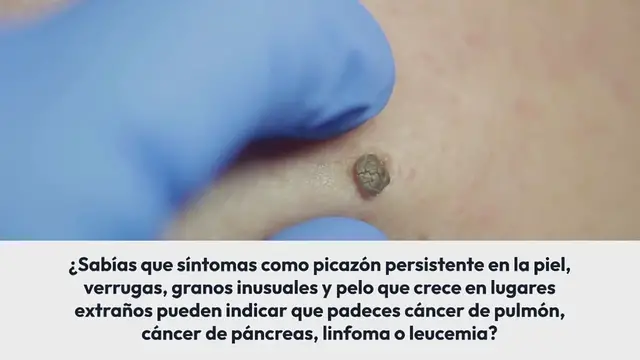 Video thumbnail for Estos son los síntomas de cáncer que son visibles en la piel