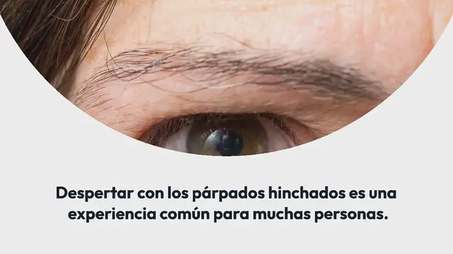 Video thumbnail for Párpados hinchados al despertar y sus causas ocultas que pueden indicar complicaciones