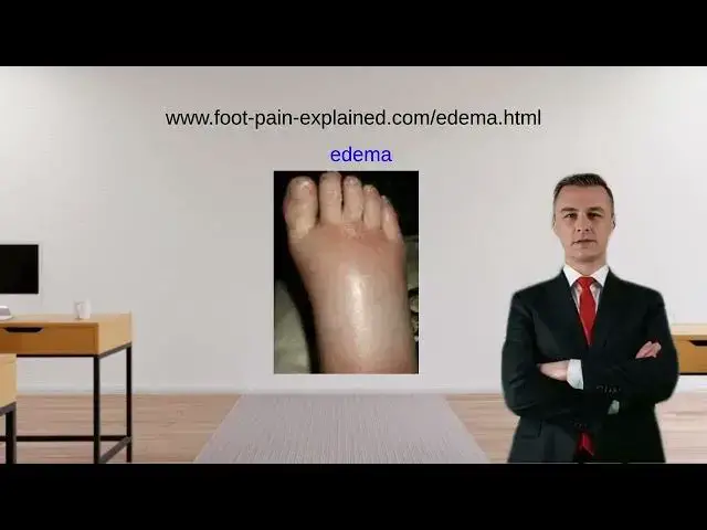 'Video thumbnail for edema of the feet'