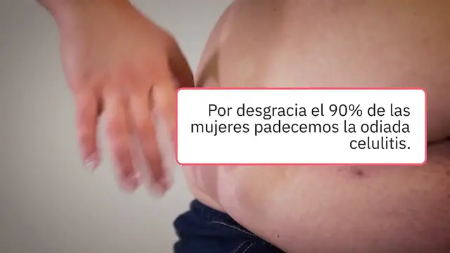 Video thumbnail for Tipos de celulitis