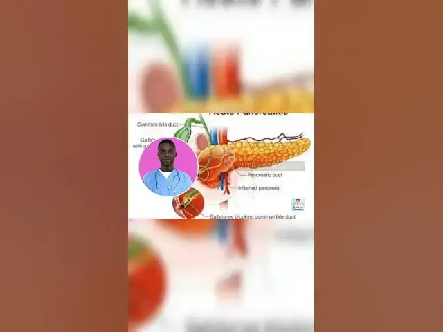 Video thumbnail for How alcohol causing pancreatitis #alcohol #pancreatitis #Gallstones #usmle #frcs #exam#student